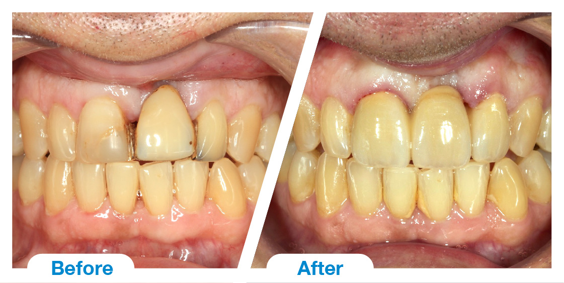 3 Unit Zirconia Bridge (Courtesy of Dr Will South) Adelaide Dental Art