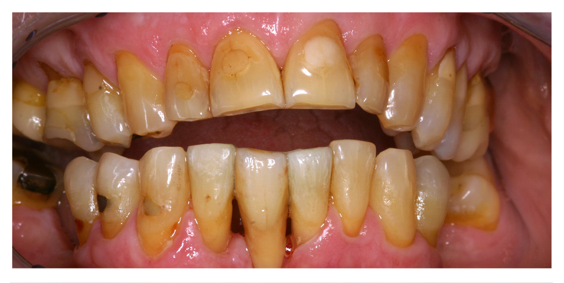 Maryland Bridge on 41 Tooth (Courtesy of Dr Hell) Adelaide Dental Art